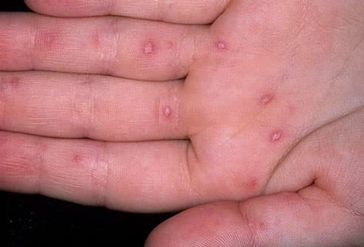 Hand-Foot-and-Mouth Disease Hand-Foot-and-Mouth Disease