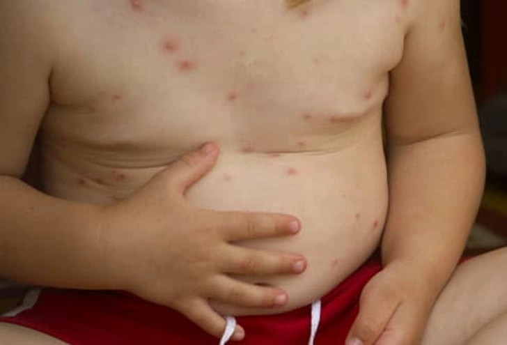 Chickenpox Chickenpox