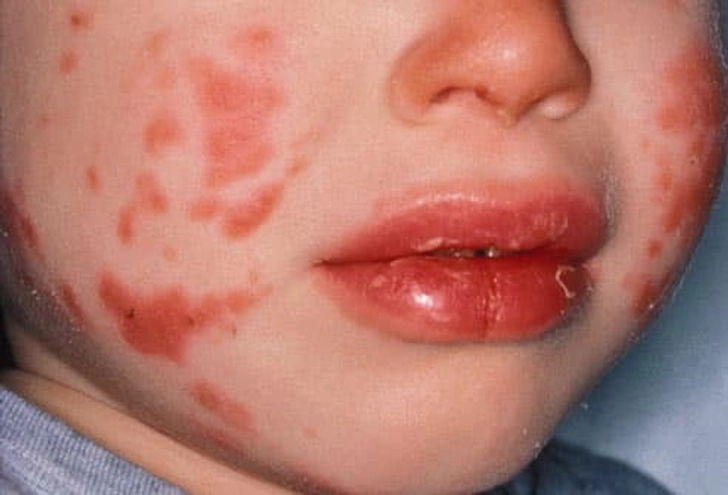 Kawasaki Disease Kawasaki Disease