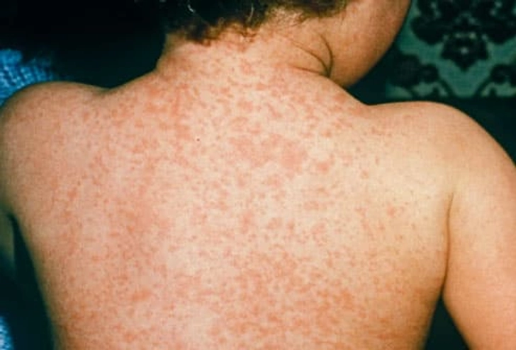 Measles Measles
