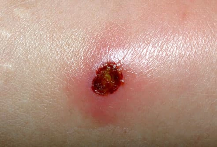 MRSA/Staph Infection MRSA/Staph Infection