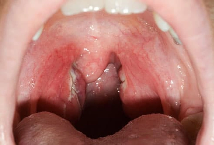 Strep Throat Strep Throat