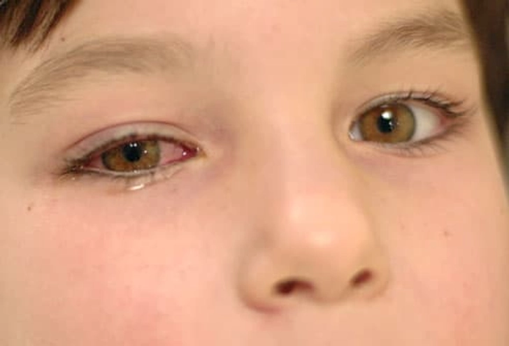 Pinkeye Pinkeye