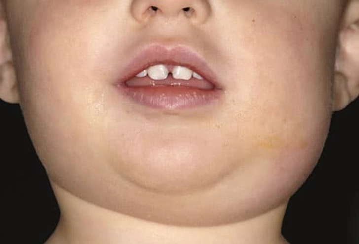 Mumps Mumps