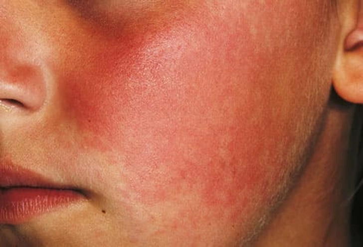 Fifth Disease Fifth Disease