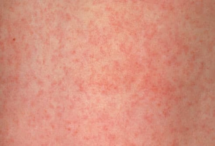 Rubella (German Measles) Rubella (German Measles)