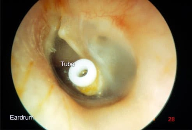 Glue Ear Glue Ear