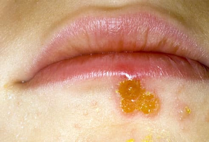 Impetigo Impetigo