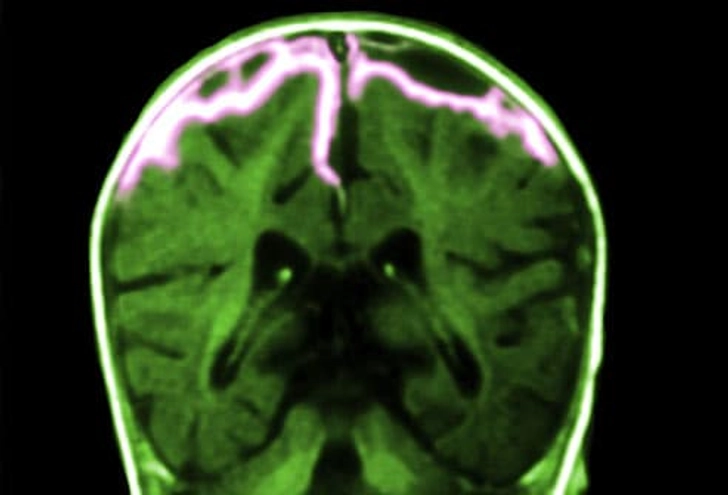 Meningitis Meningitis