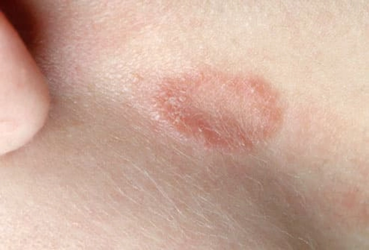 Ringworm