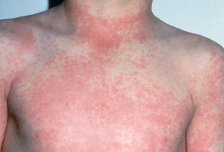 Scarlet Fever Scarlet Fever