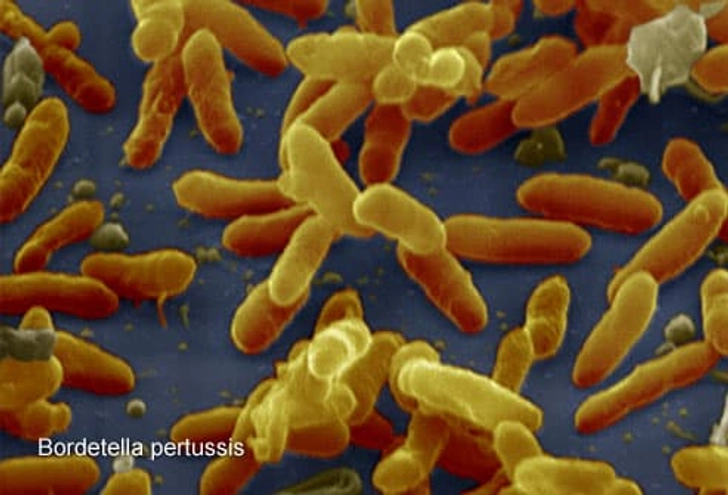 Whooping Cough (Pertussis) Whooping Cough (Pertussis)