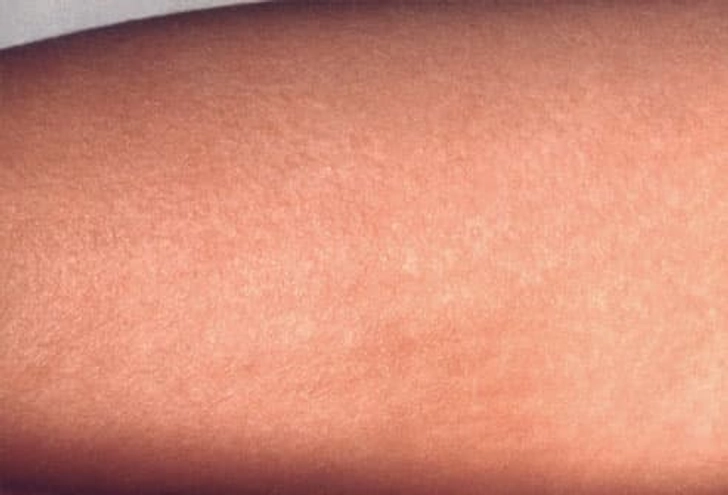 Scarlet Fever