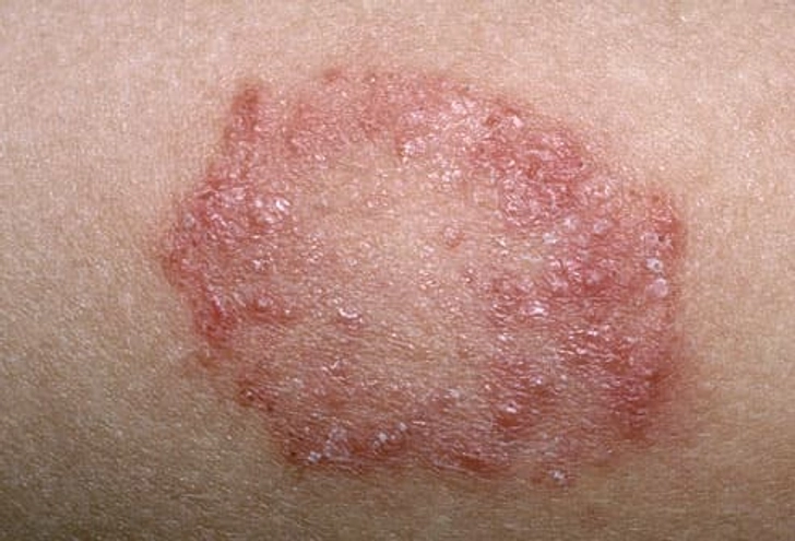 Ringworm