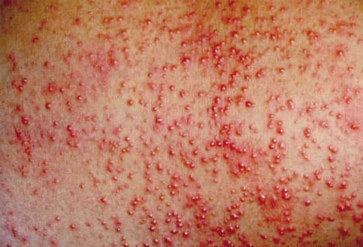 Heat Rash ('Prickly Heat')
