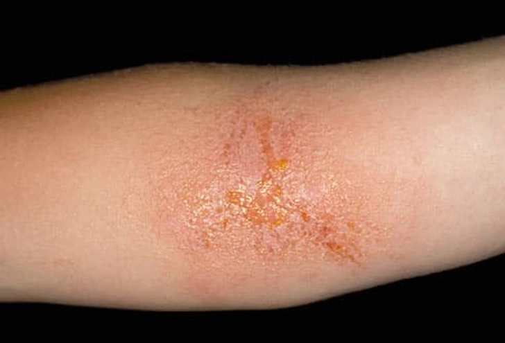 Contact Dermatitis