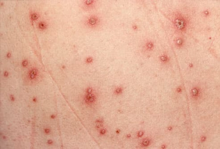 Chickenpox Chickenpox