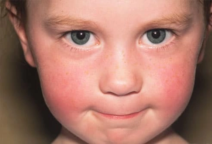 Fifth Disease