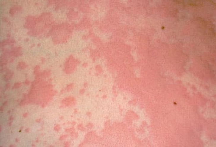 Hives Hives