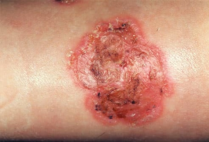 Impetigo Impetigo