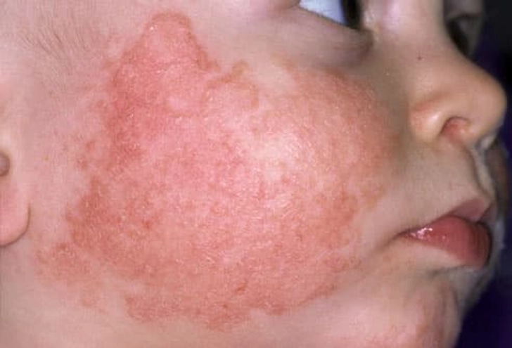 Eczema