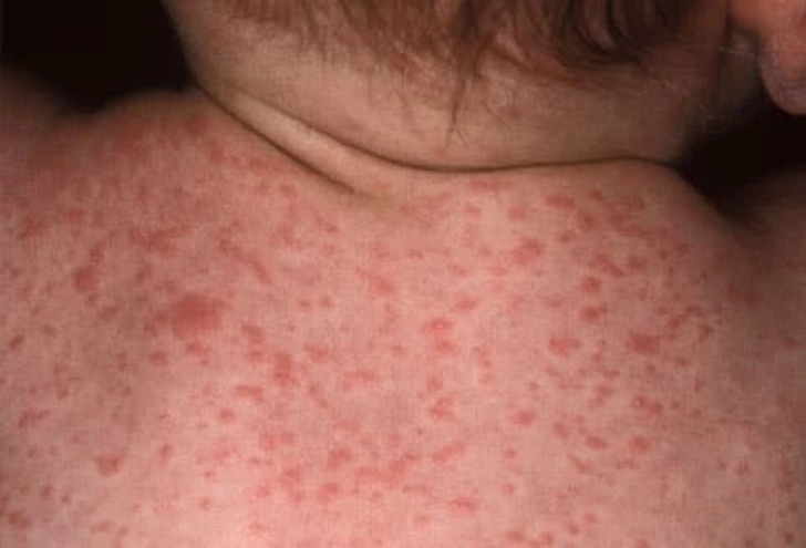 Roseola (Sixth Disease)