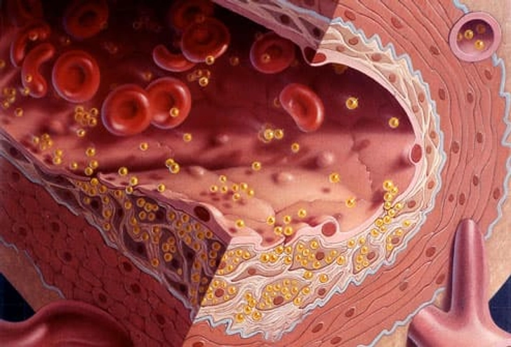 Symptoms of High Cholesterol