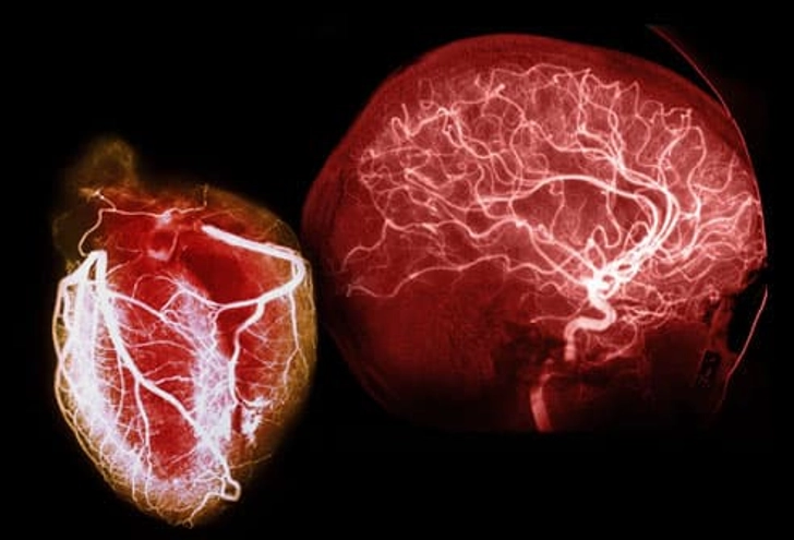 Why High Cholesterol Matters Why High Cholesterol Matters