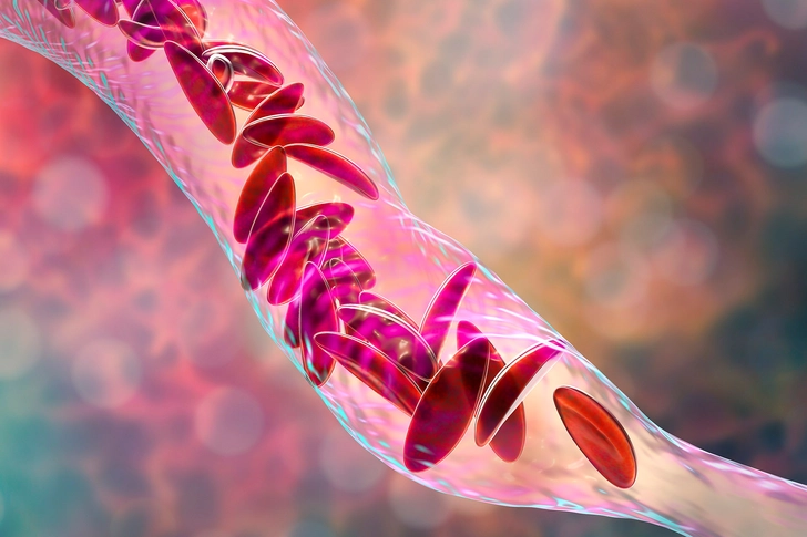 Sickle Cell Disease