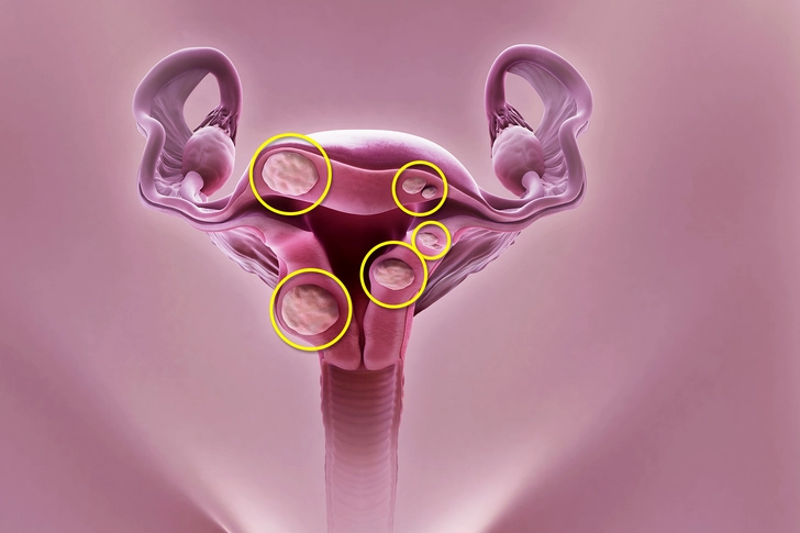 Uterine Fibroids