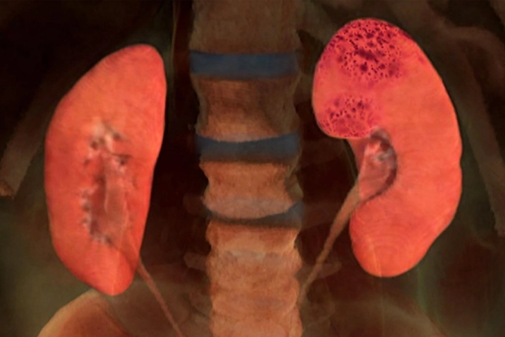 Kidney Disease