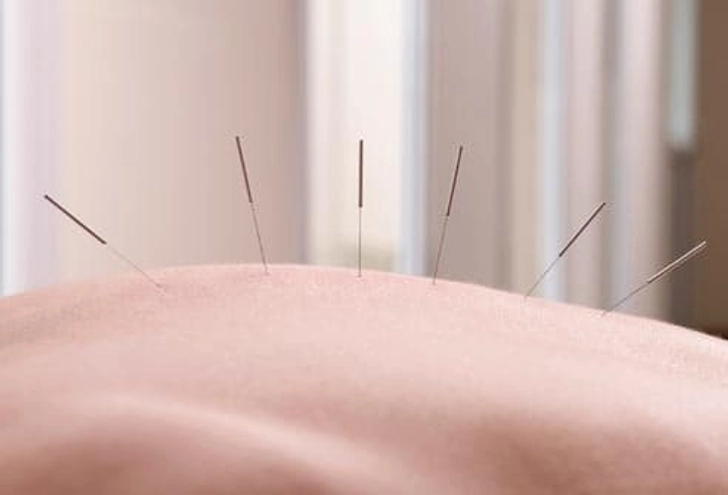 Pain Relief: Acupuncture
