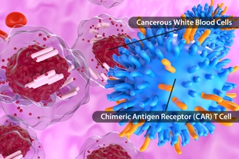 CAR T Immunotherapy