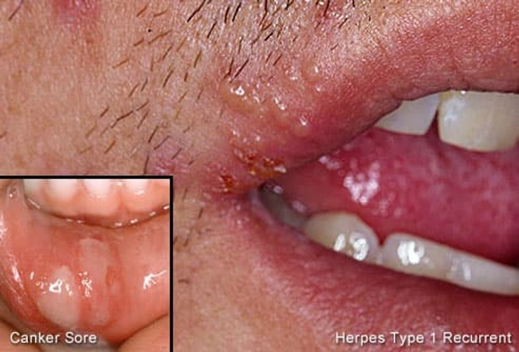Canker Sores Aren't the Same