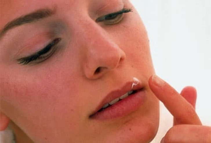 Antiviral Creams Can Help