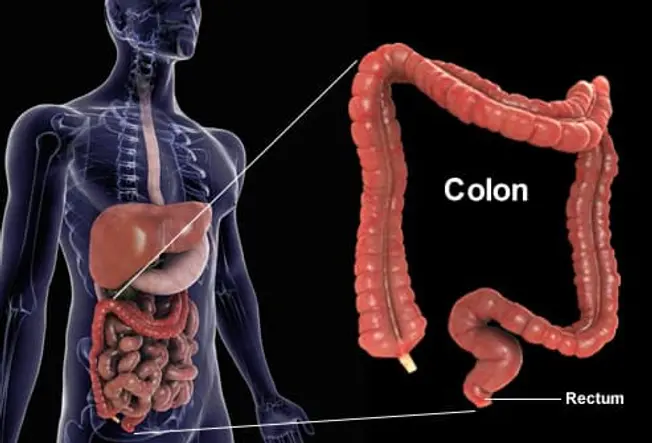 Colorectal Cancer: What Is It?