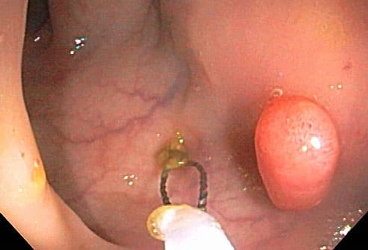 Tests That Find Colorectal Cancer