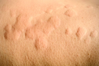 Allergic Reaction Allergic Reaction