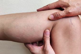 Visible Pink or Red Blood Vessels Visible Pink or Red Blood Vessels