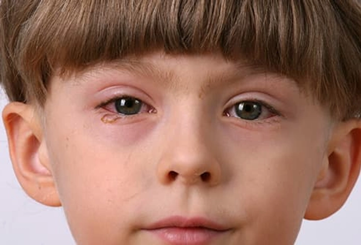 Pinkeye (Conjunctivitis)