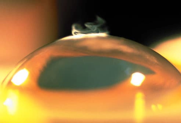Refractive Eye Surgery Refractive Eye Surgery
