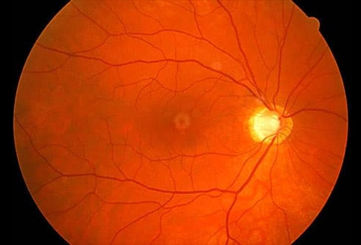 Glaucoma: What Happens