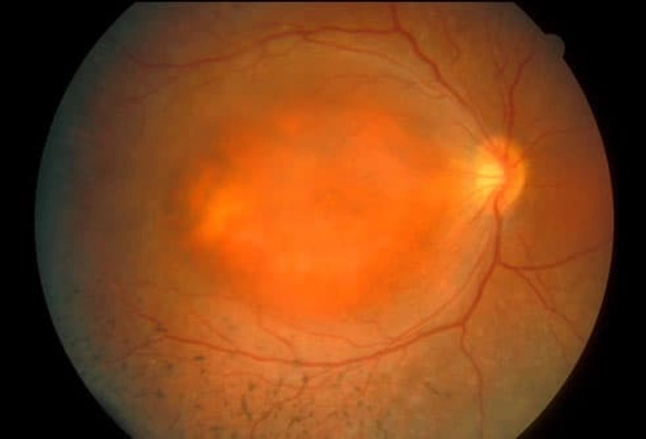 Retinitis Pigmentosa: What Happens