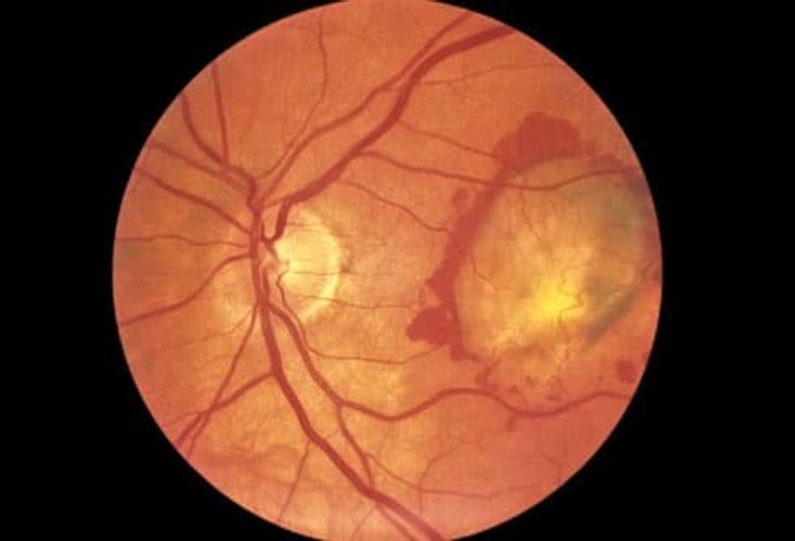 Macular Degeneration: What Happens