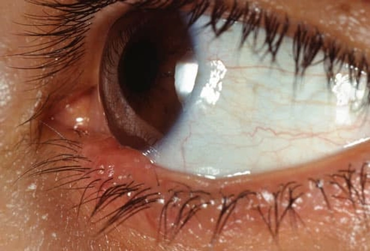 Stye