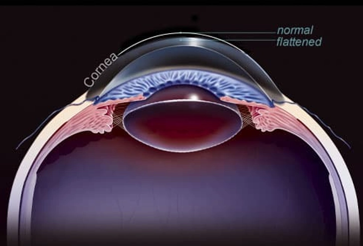 Astigmatism