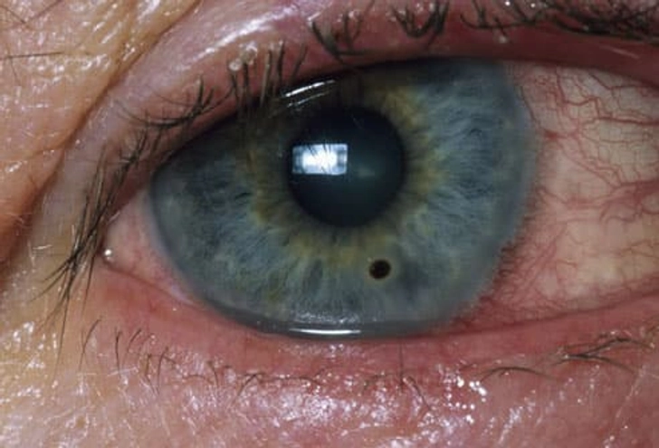 Object in the Eye
