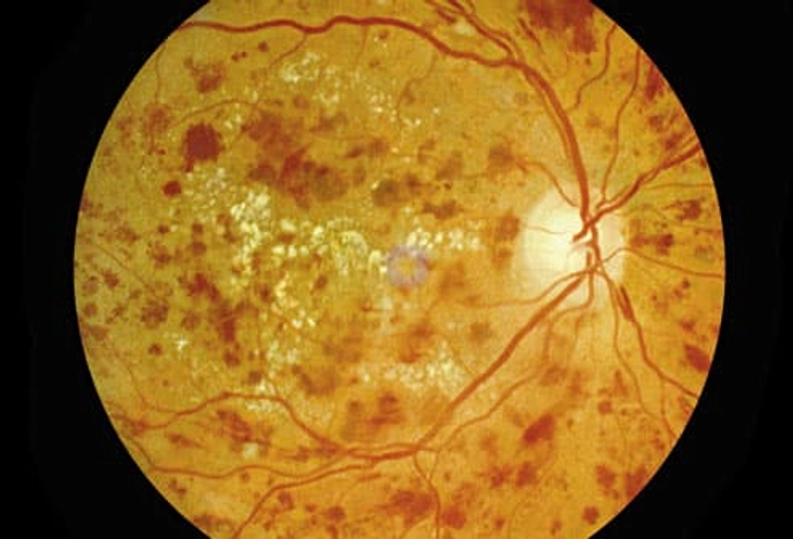 Diabetic Retinopathy: What Happens