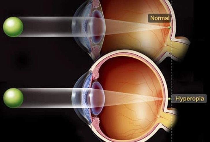 Farsightedness: What Happens