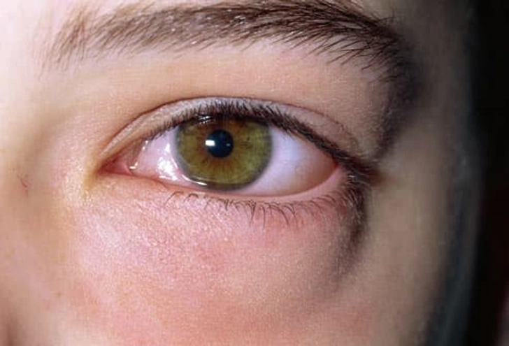 Allergies Allergies